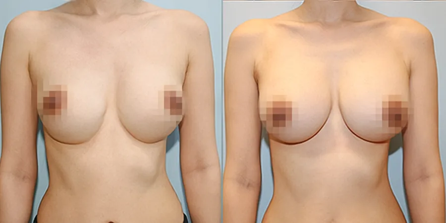 겨드랑이 절개하 재수술 수술 전후사진 — 케이스 29
